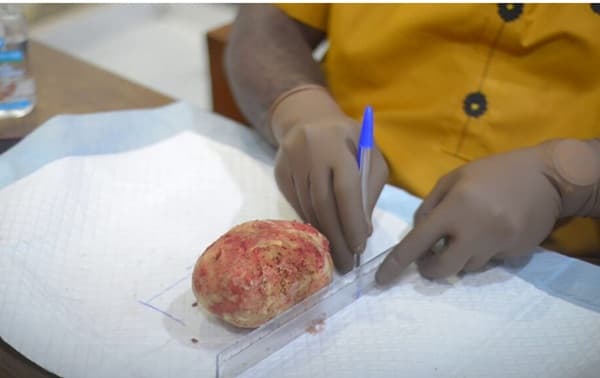 Kumasi doctors remove 880-gram bladder stone from 49-year-old man