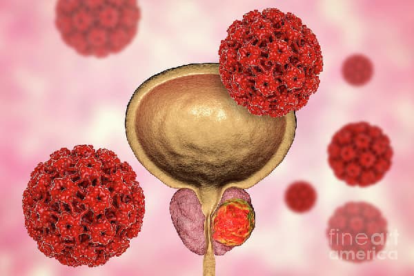 Early detection key to reducing prostate cancer deaths – Urologist