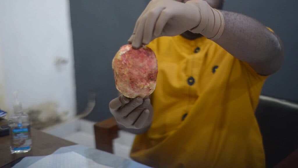 Kumasi Hospital removes 880-gram bladder stone in rare surgical case